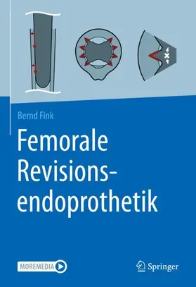 Fink |  Femorale Revisionsendoprothetik | Buch |  Sack Fachmedien