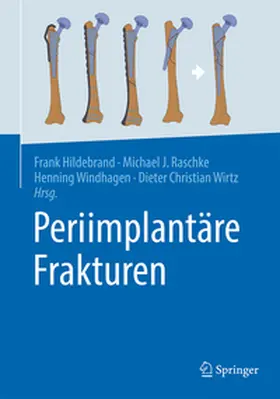 Hildebrand / Raschke / Windhagen |  Periimplantäre Frakturen | Buch |  Sack Fachmedien