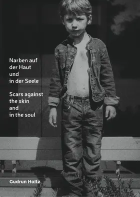 Holtz |  Narben auf der Haut und in der Seele | eBook | Sack Fachmedien