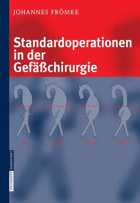 Frömke |  Standardoperationen in der Gefäßchirurgie | eBook | Sack Fachmedien
