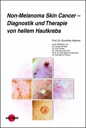 Nashan |  Non-Melanoma Skin Cancer - Diagnostik und Therapie von hellem Hautkrebs | eBook | Sack Fachmedien