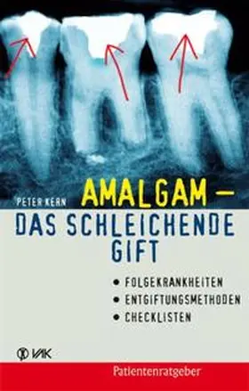 Kern |  Amalgam - das schleichende Gift | Buch |  Sack Fachmedien