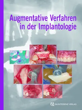 Khoury |  Augmentative Verfahren in der Implantologie | eBook | Sack Fachmedien