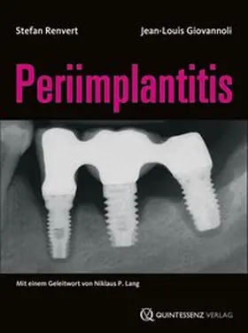 Renvert / Giovannoli |  Periimplantitis | Buch |  Sack Fachmedien