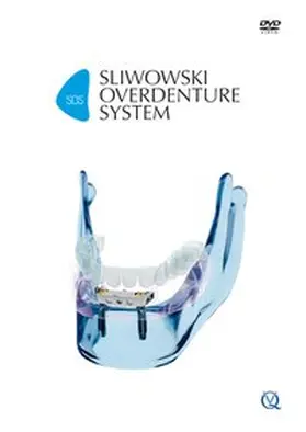 Sliwowski | SOS – Sliwowski Overdenture System | Sonstiges | 978-3-86867-336-4 | sack.de