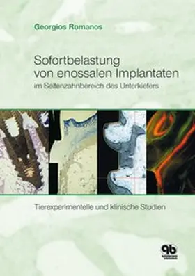 Romanos |  Sofortbelastung von enossalen Implantaten im Seitenzahnbereich des Unterkiefers | Buch |  Sack Fachmedien