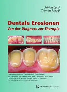 Lussi / Jaeggi |  Dentale Erosionen | Buch |  Sack Fachmedien