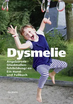 Martin |  Dysmelie Angeborene Gliedmaßenfehlbildung/-en | Buch |  Sack Fachmedien