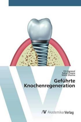 Agrawal / Chopra / Sharma |  Geführte Knochenregeneration | Buch |  Sack Fachmedien