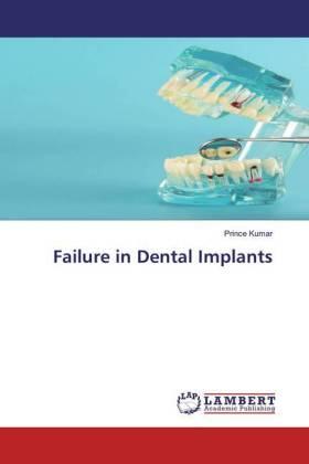 Kumar |  Failure in Dental Implants | Buch |  Sack Fachmedien