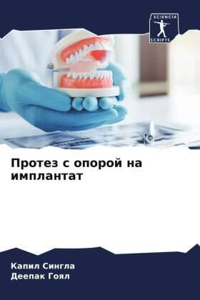 Singla / Goql |  Protez s oporoj na implantat | Buch |  Sack Fachmedien