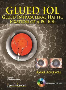 Agarwal |  GLUED IOL | Buch |  Sack Fachmedien