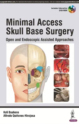 Boahene / Quiñones-Hinojosa |  Minimal Access Skull Base Surgery | Buch |  Sack Fachmedien