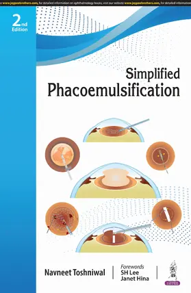 Toshniwal |  Simplified Phacoemulsification | Buch |  Sack Fachmedien